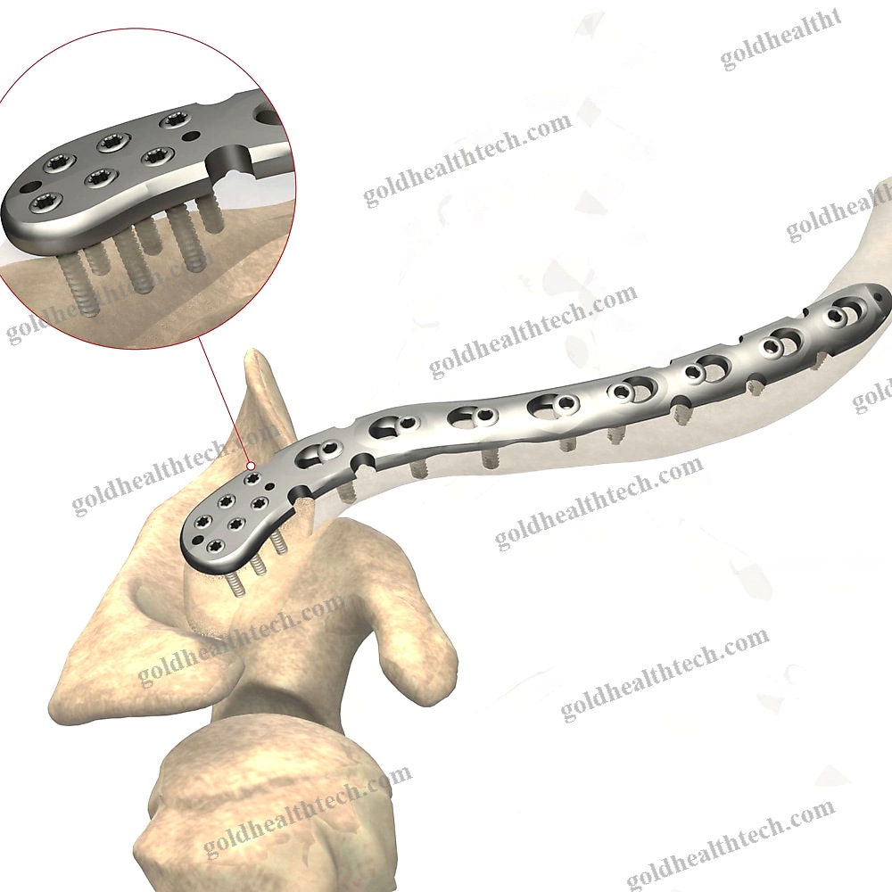 Clavicle Compression Plate