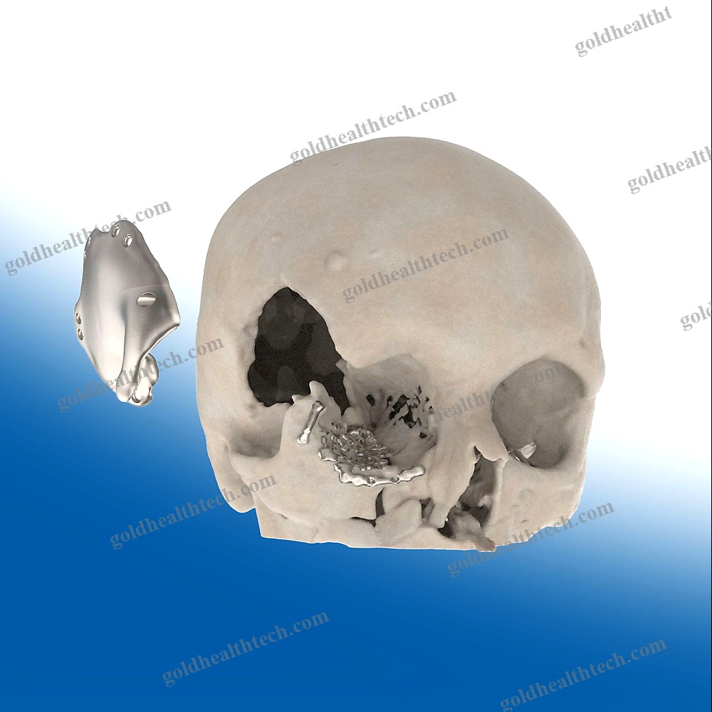 Custom-Made Cranial Implant 1
