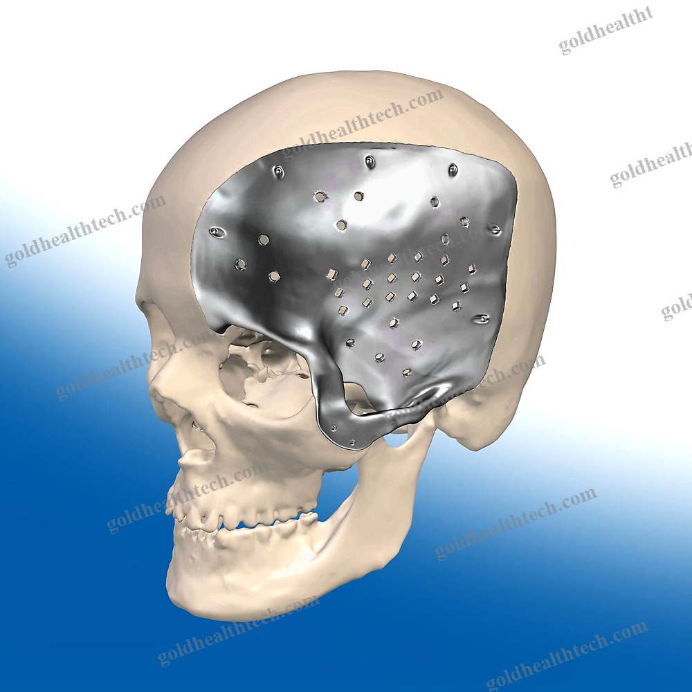 Custom-Made Cranial Implant