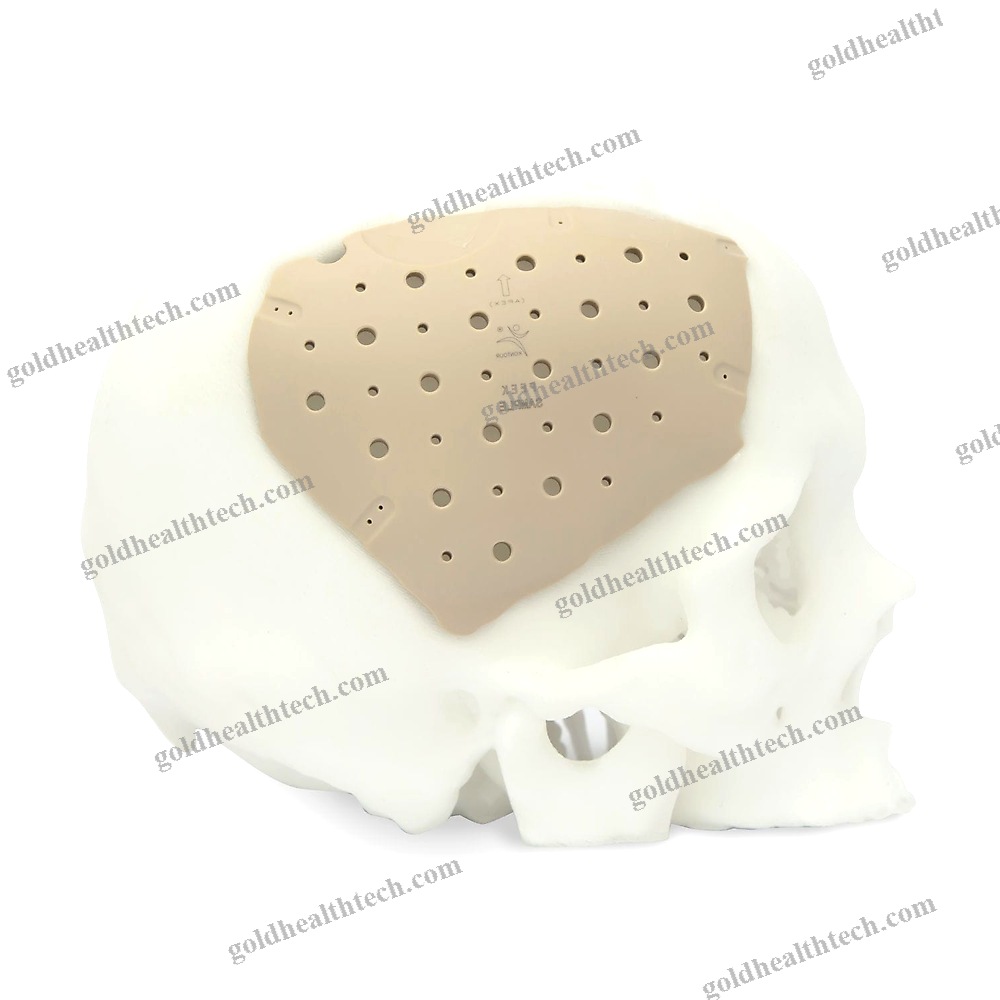 Custom-Made Cranial Implant