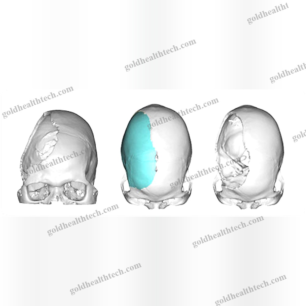 Custom-Made Cranial Implant 1
