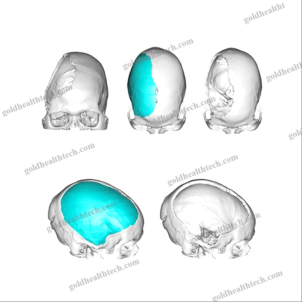 Custom-Made Cranial Implant