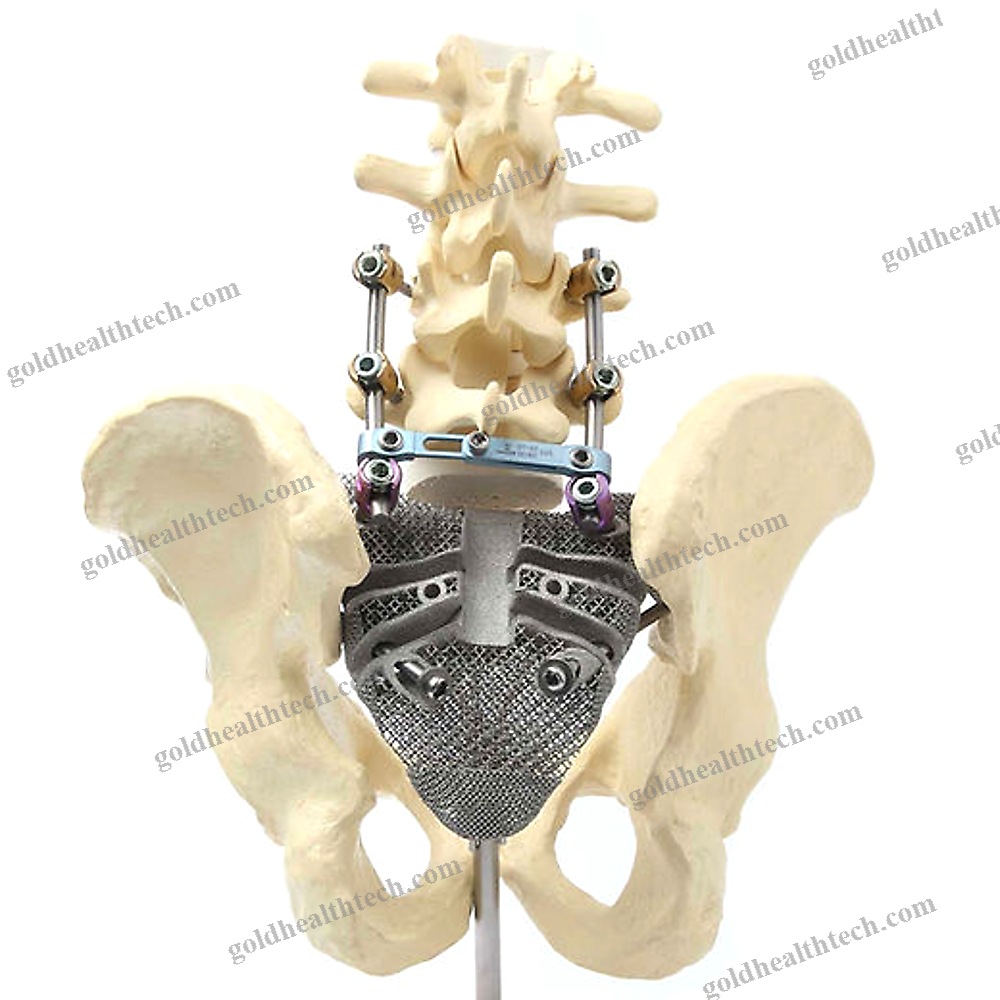 Custom-Made Cranial Implant 1