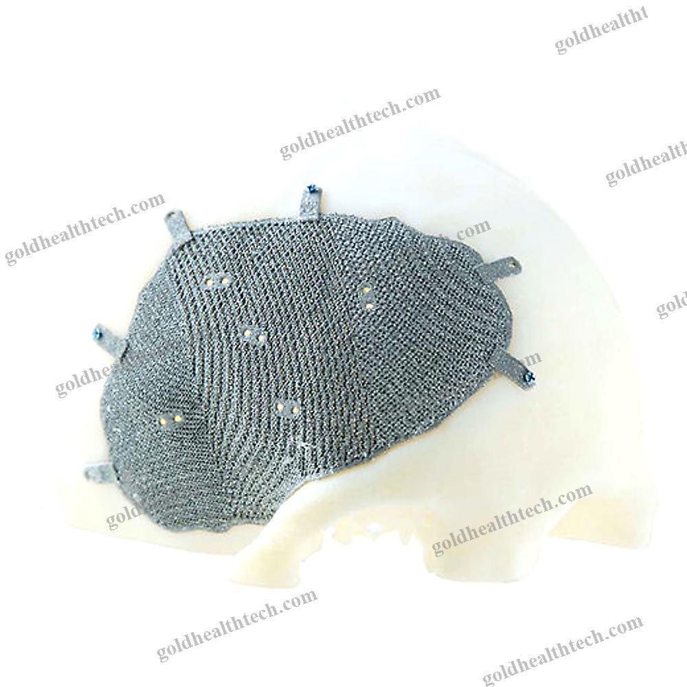Custom-Made Cranial Implant