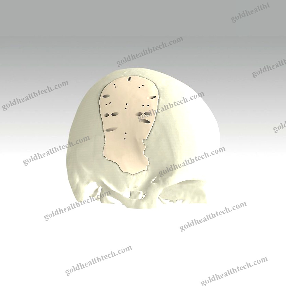 Custom-Made Cranial Implant 1