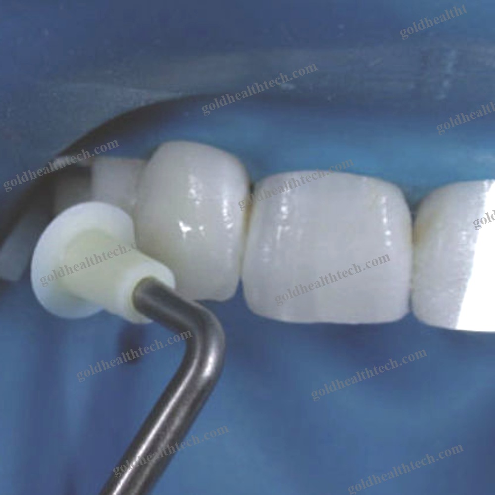 Dental Composite Modeling Instrument