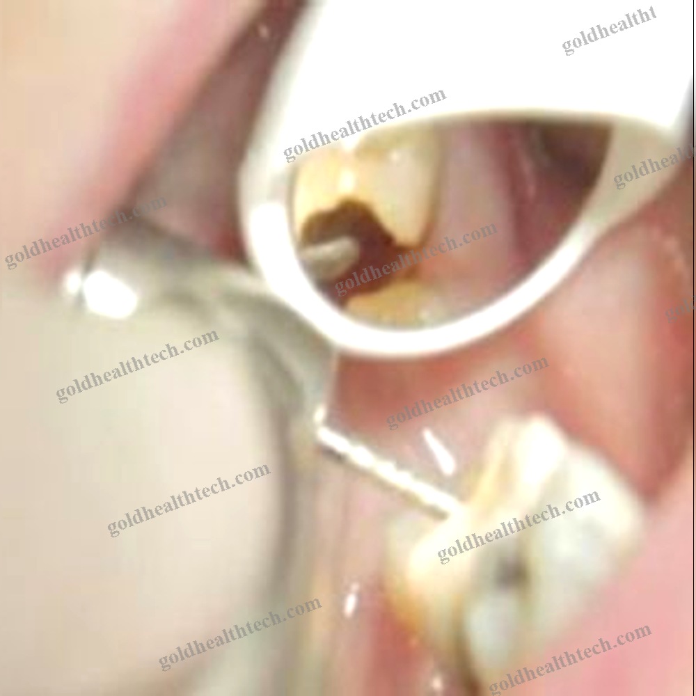 Dental Mirror 1