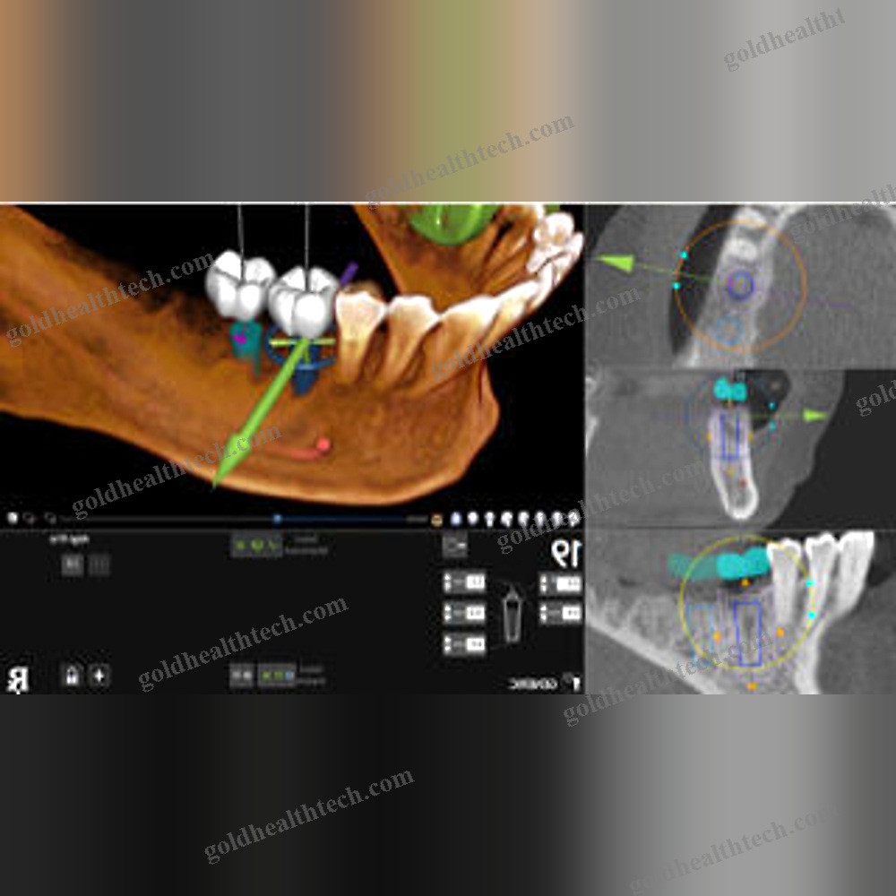Dental Surgery Surgical Navigation System 1