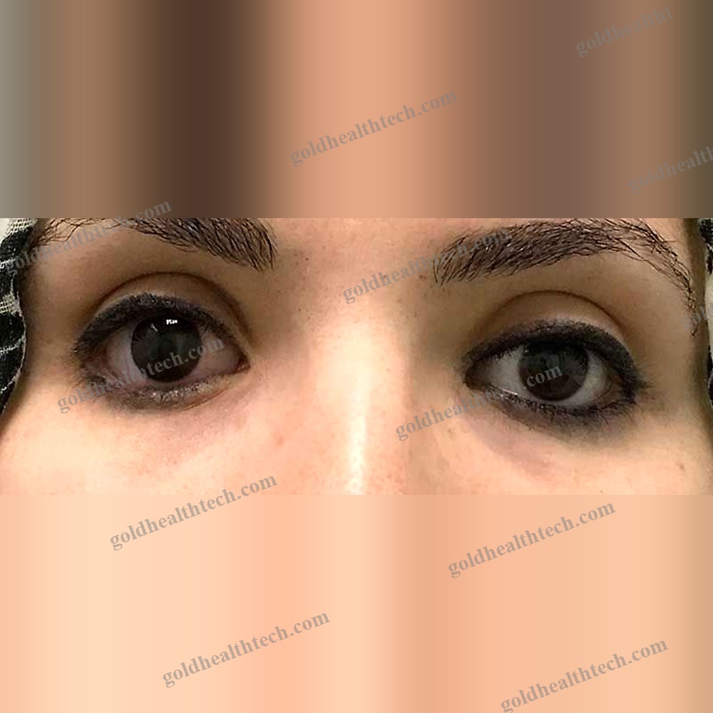 Eye Cosmetic Prosthesis