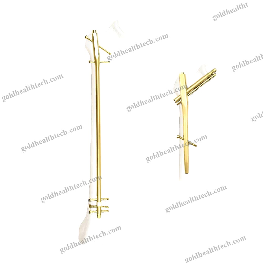 Femoral Intramedullary Nail