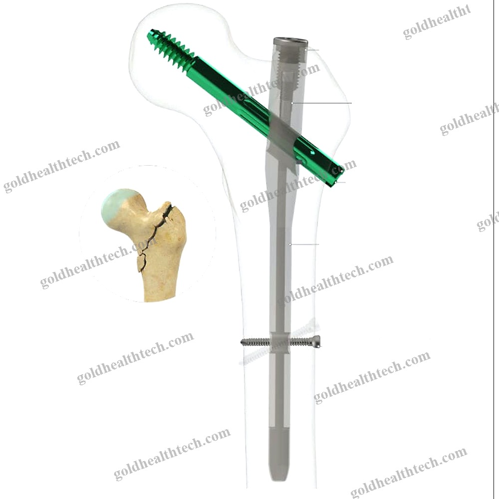 Femoral Intramedullary Nail