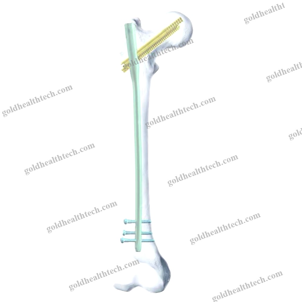 Femoral Intramedullary Nail