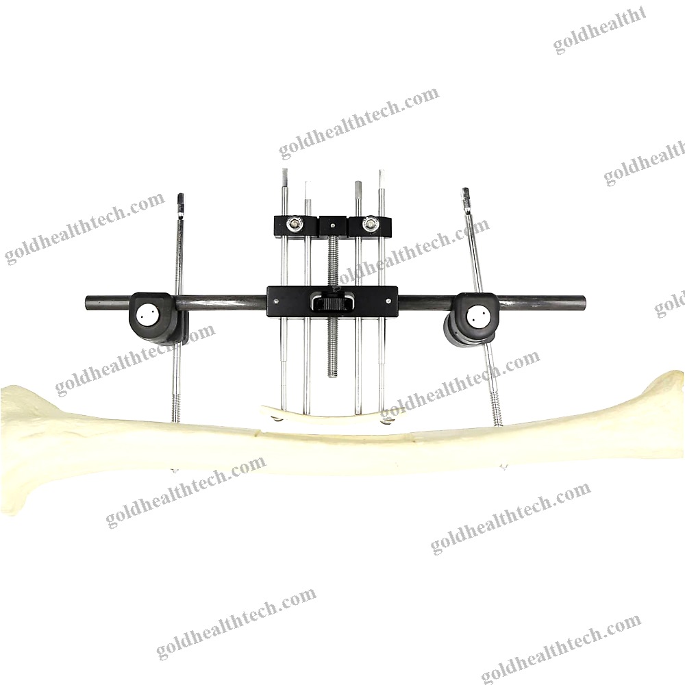 Femur External Fixation System