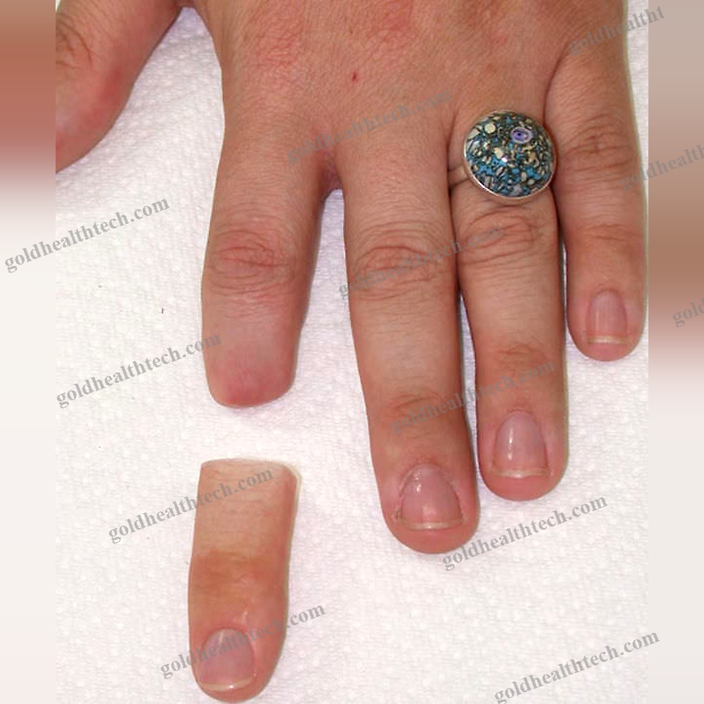 Finger Cosmetic Prosthesis