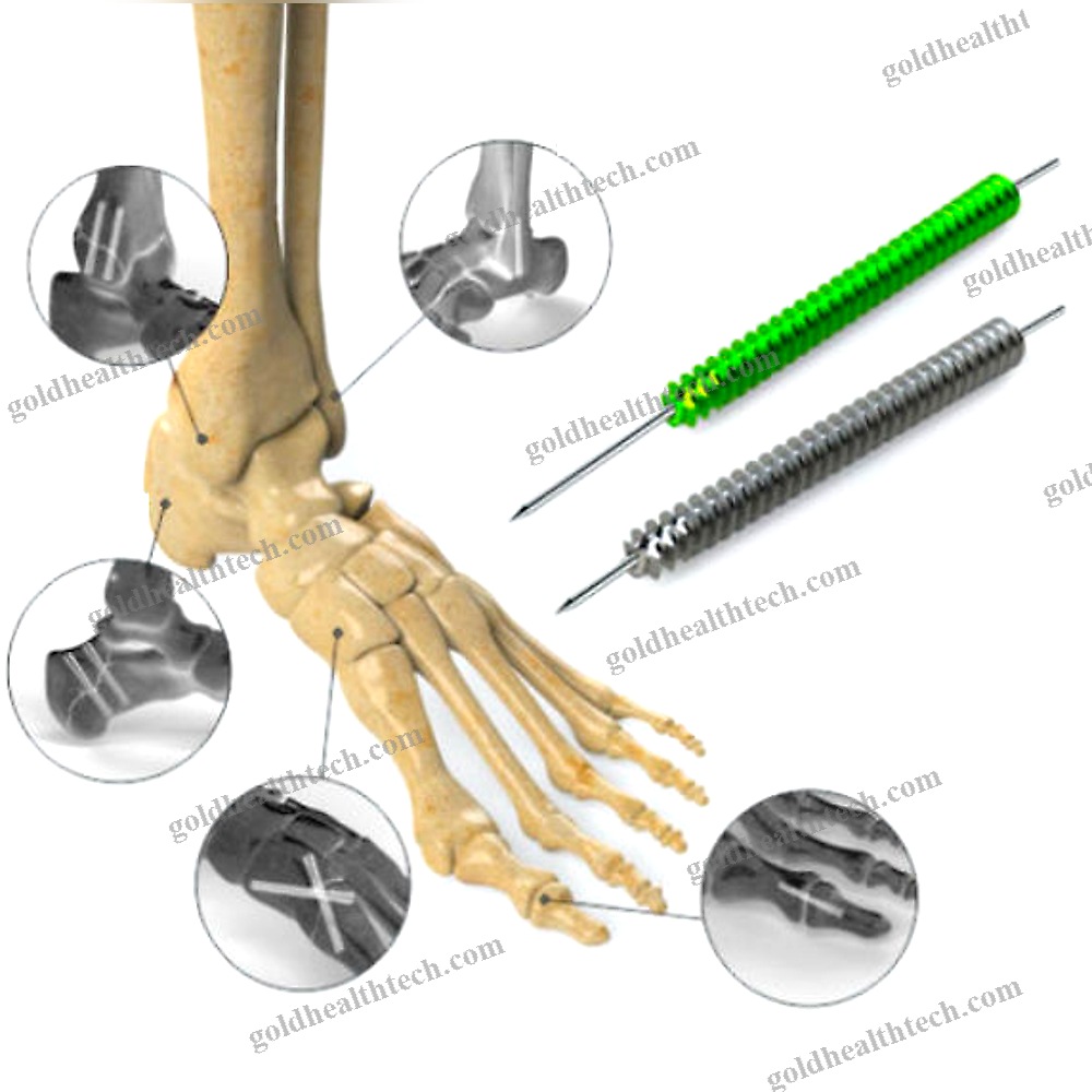 Foot Compression Bone Screw