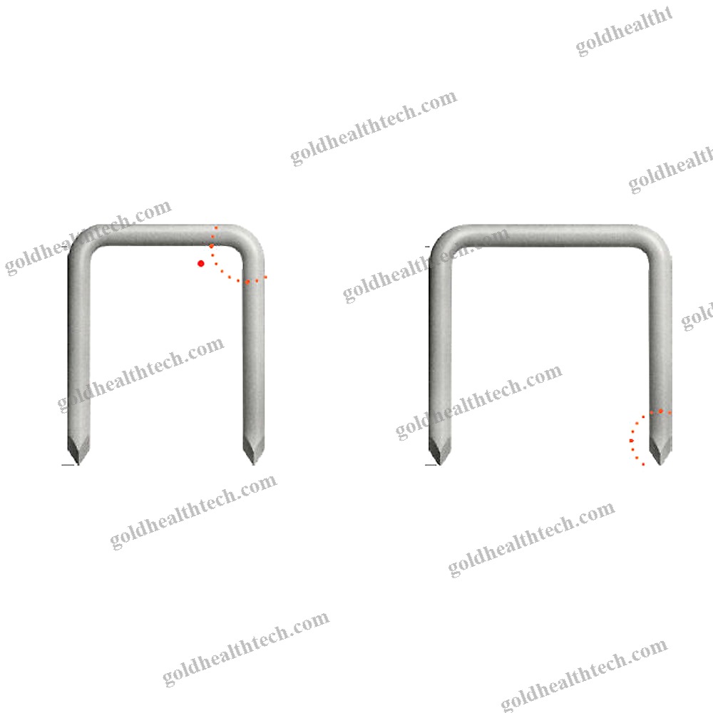 Forefoot Bone Staple