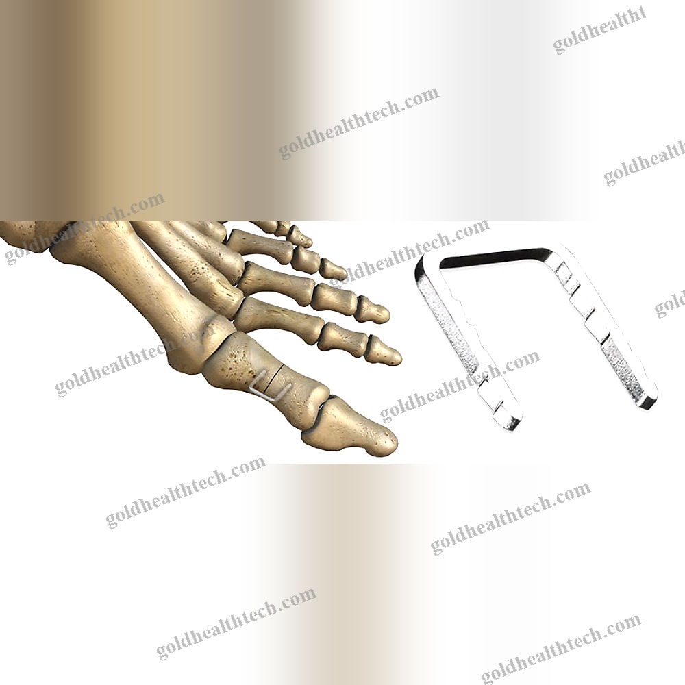 Forefoot Bone Staple