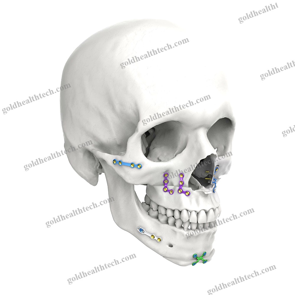 Genioplasty Compression Plate