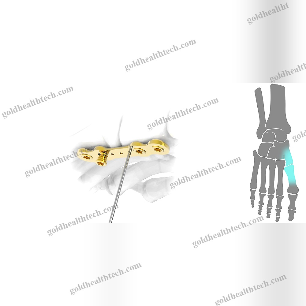 Hallux Valgus Arthrodesis Plate 1