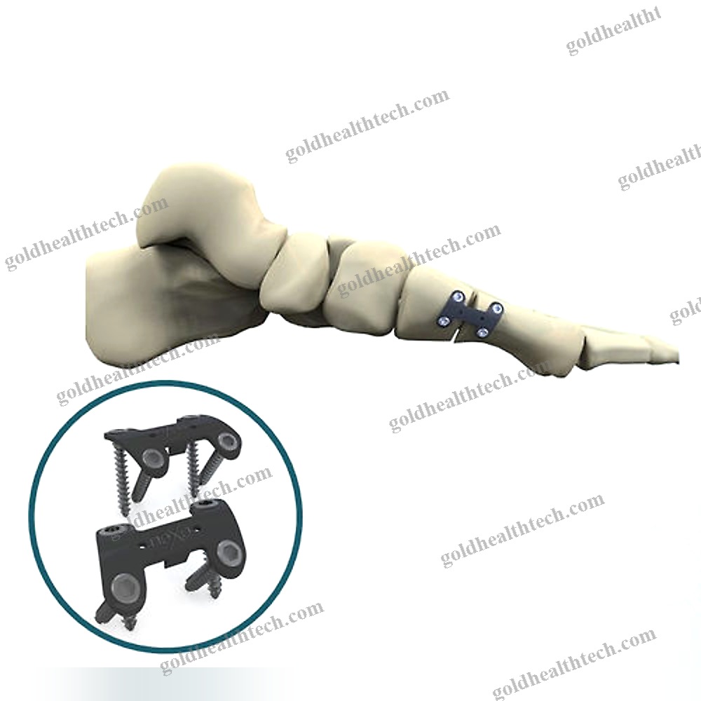 Hallux Valgus Arthrodesis Plate