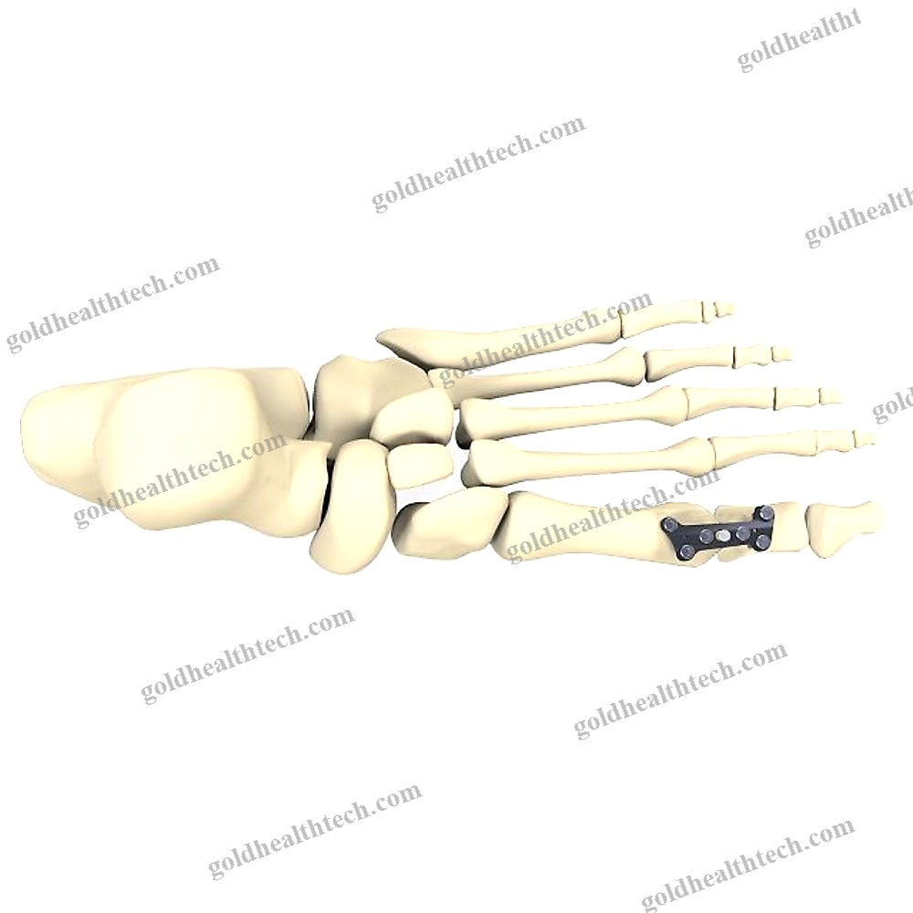 Hallux Valgus Arthrodesis Plate
