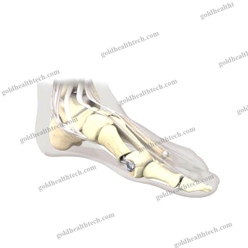 Hallux Valgus Osteotomy Screw