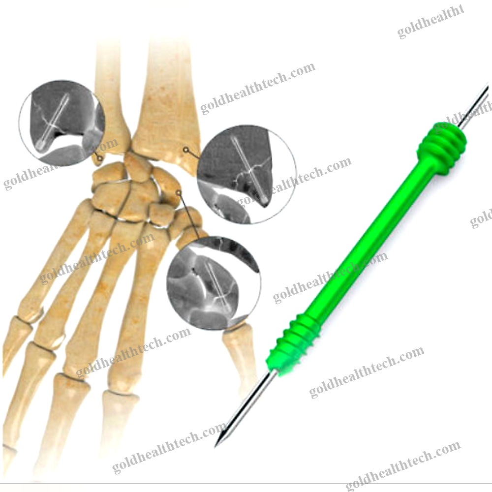 Hand Compression Bone Screw