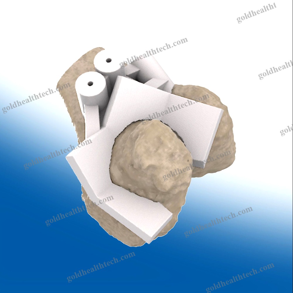 Hip Prosthesis Resection Guide