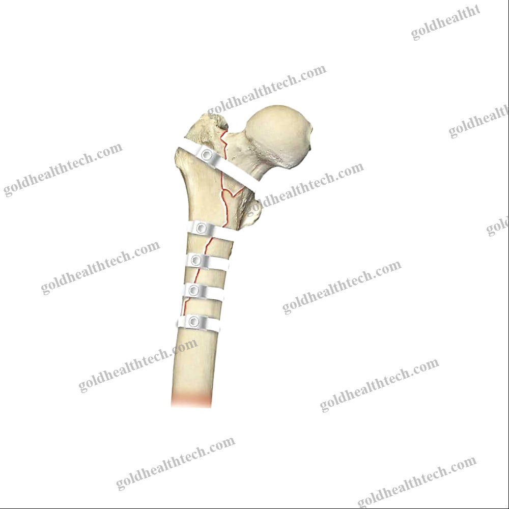 Hip Revision Surgery Bone Cerclage Wiring