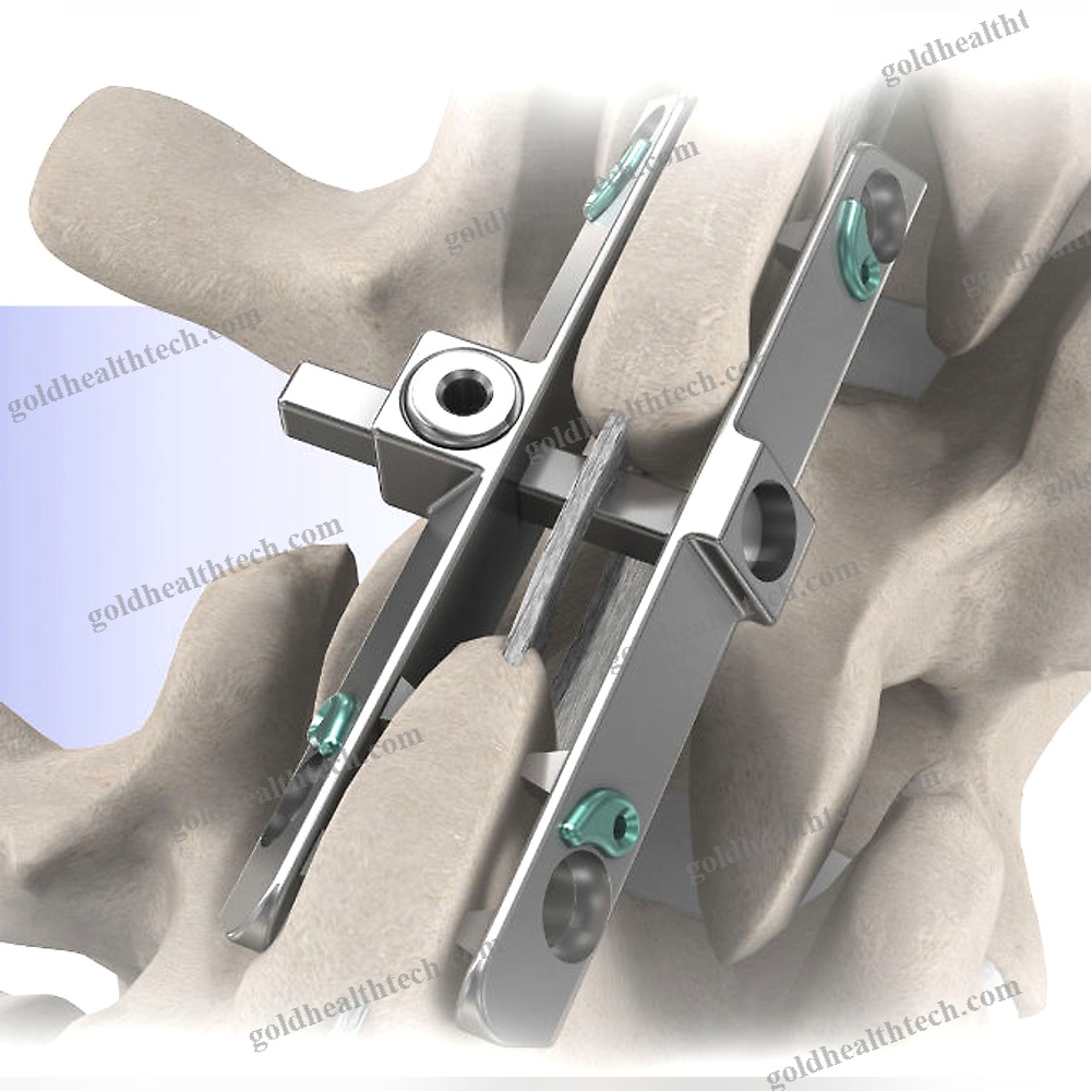 Lumbar Interspinous Vertebral Implant 1