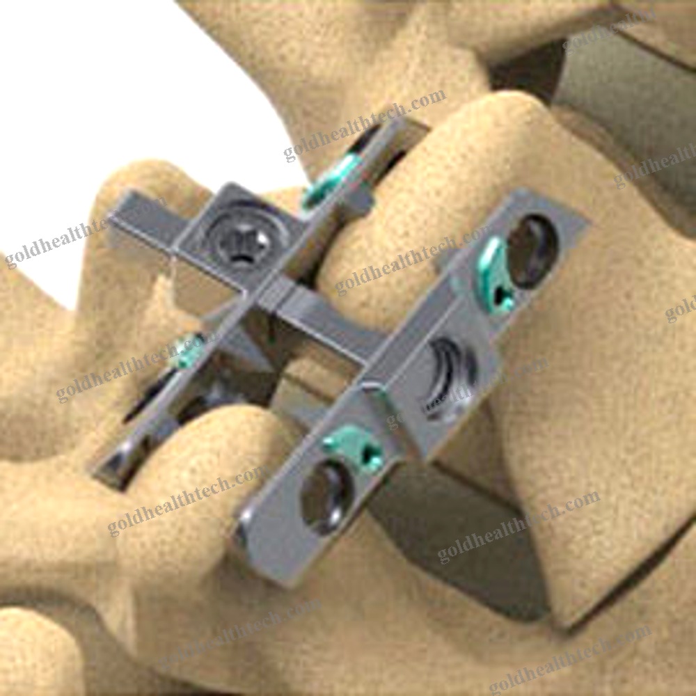 Lumbar Interspinous Vertebral Implant