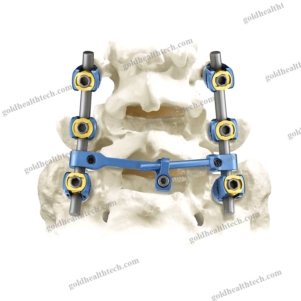 Lumbar-Sacral Vertebra Pedicle Screw 1