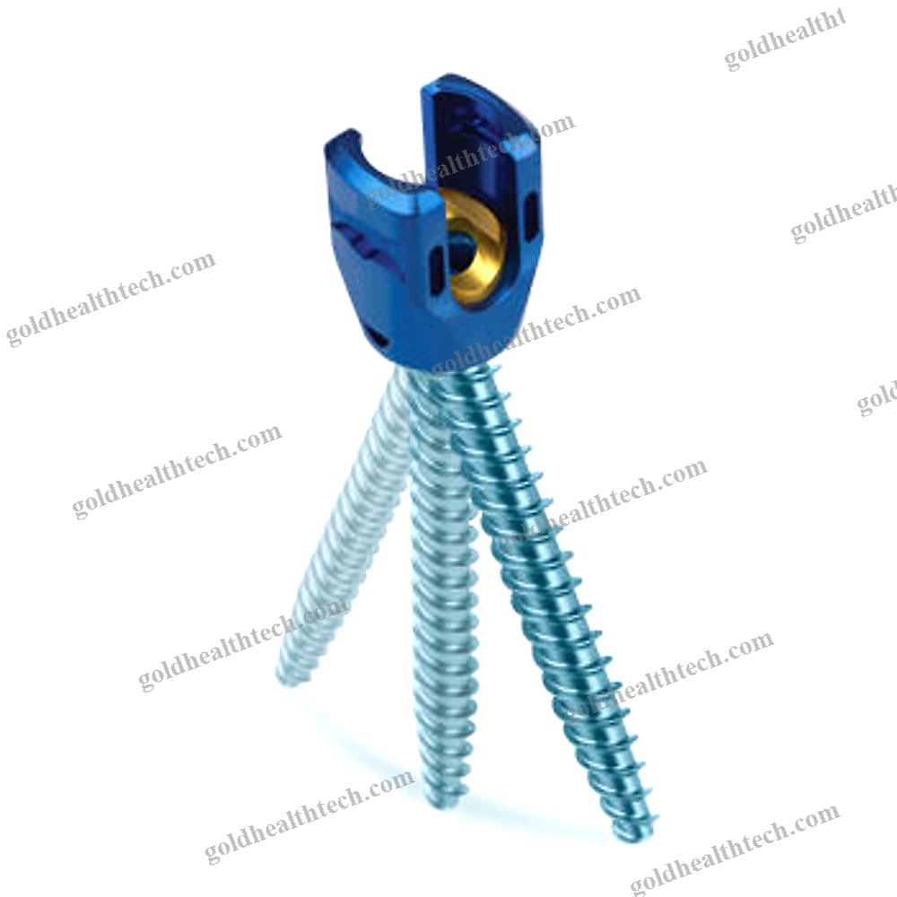 Lumbar-Sacral Vertebra Pedicle Screw