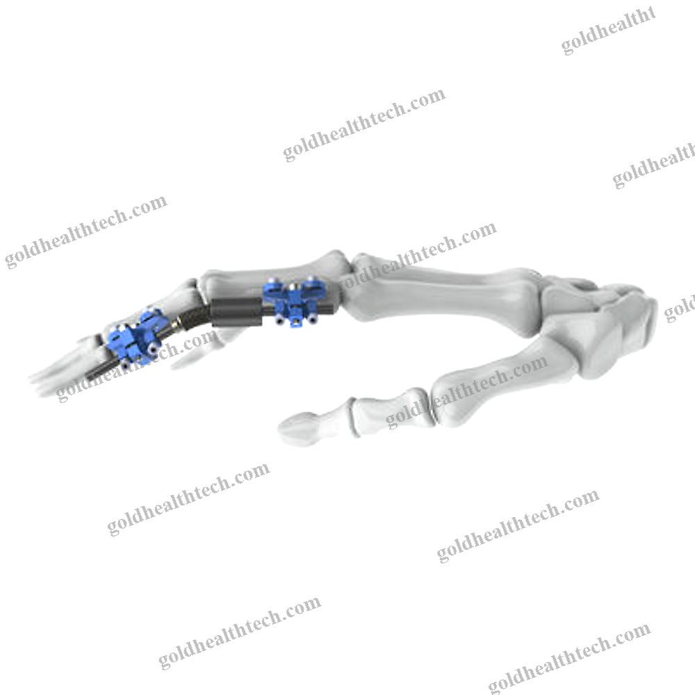 Metacarpophalangeal Joint External Fixation System 1