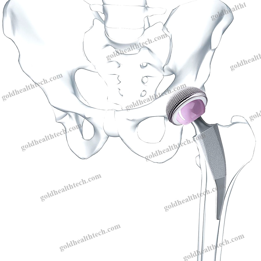 Minimally Invasive Hip Prosthesis