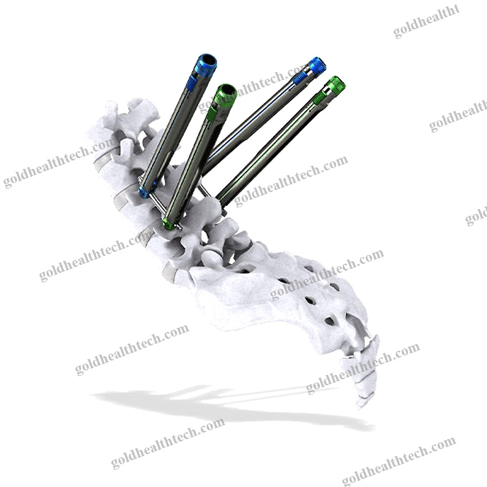 Minimally Invasive Pedicle Screw Positioning System
