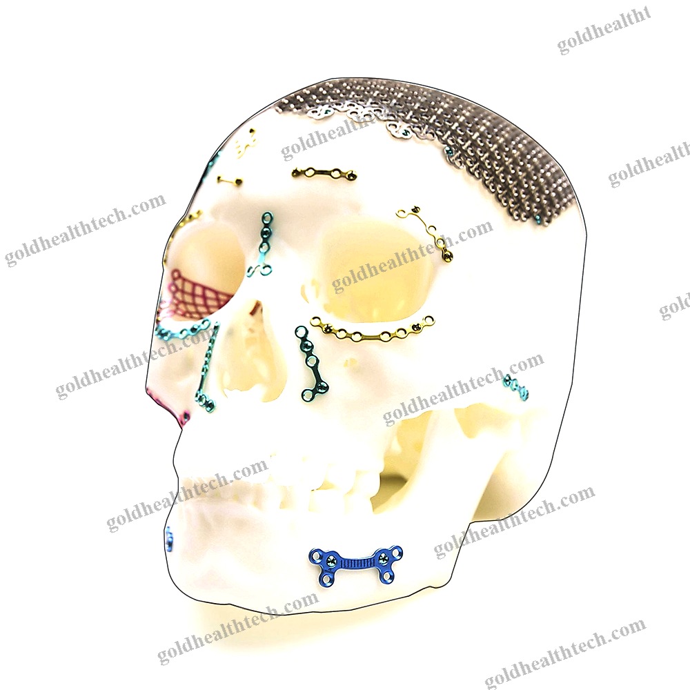 Non-Absorbable Cranial Fixation System