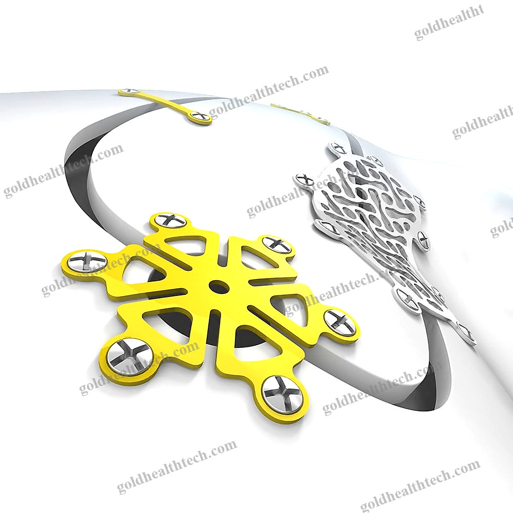 Non-Absorbable Cranial Fixation System