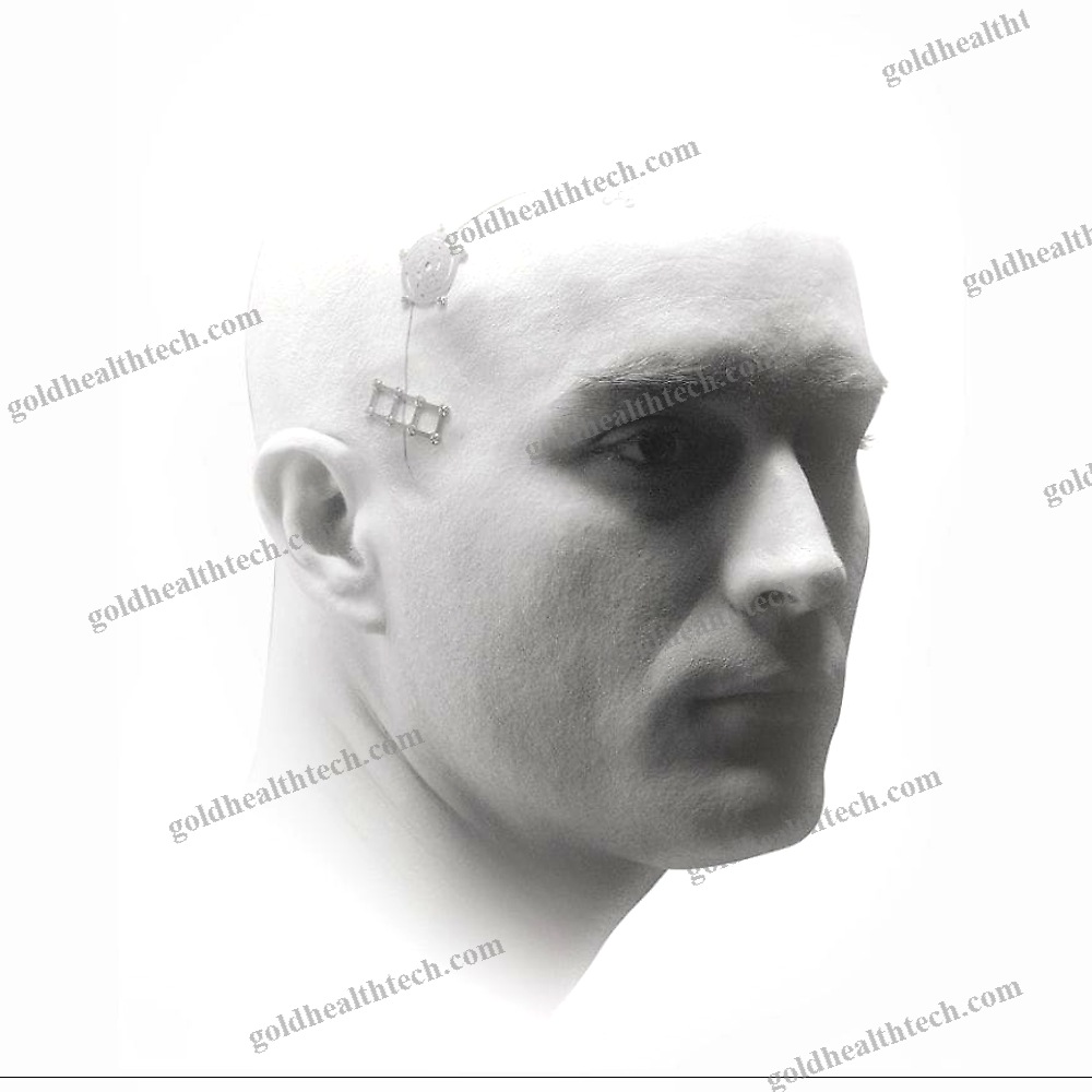 Non-Absorbable Cranial Fixation System