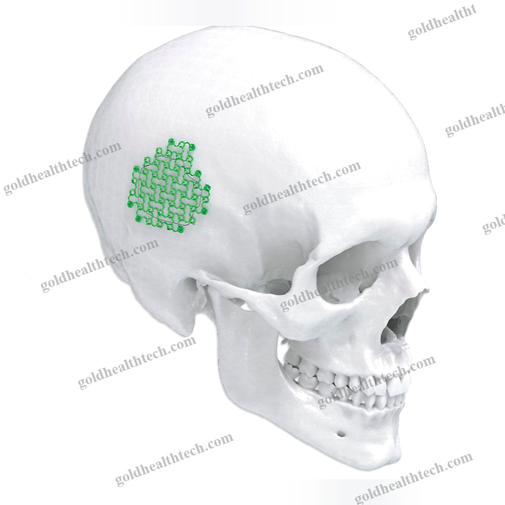 Non-Absorbable Cranial Fixation System