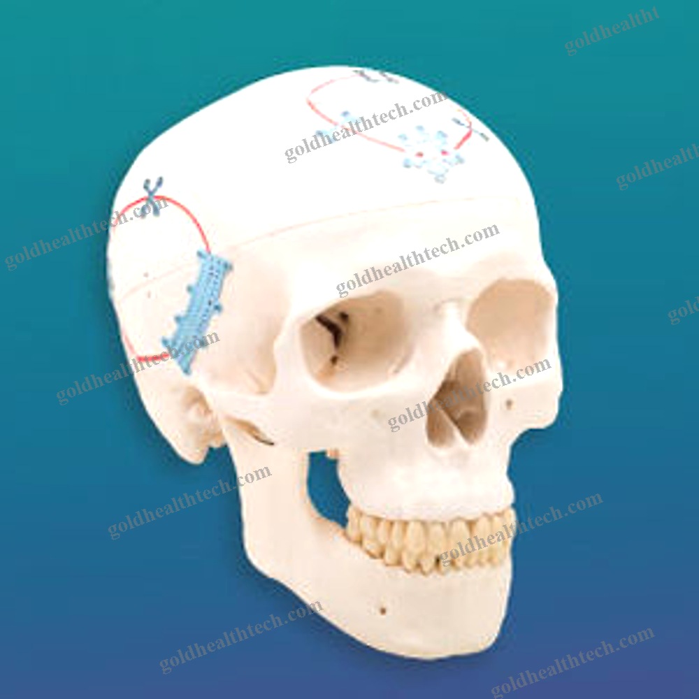 Non-Absorbable Cranial Fixation System