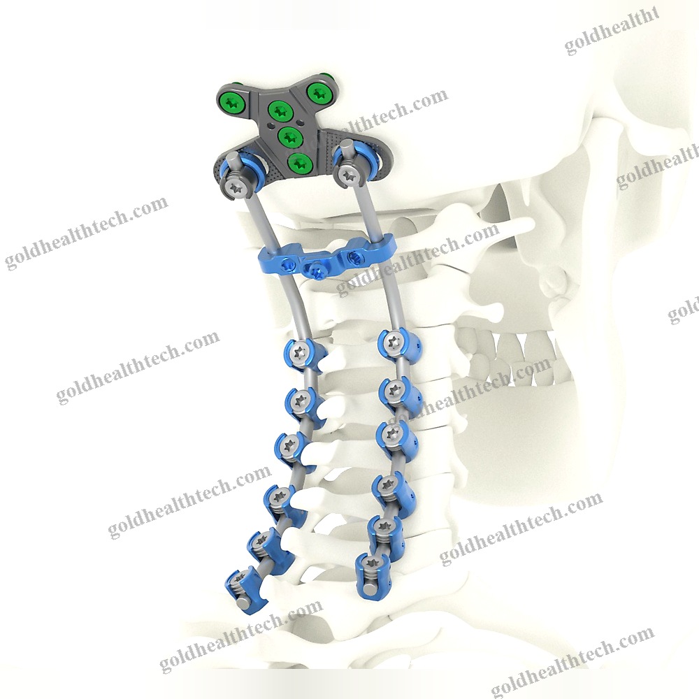 Occipito-Cervico-Thoracic Osteosynthesis Unit