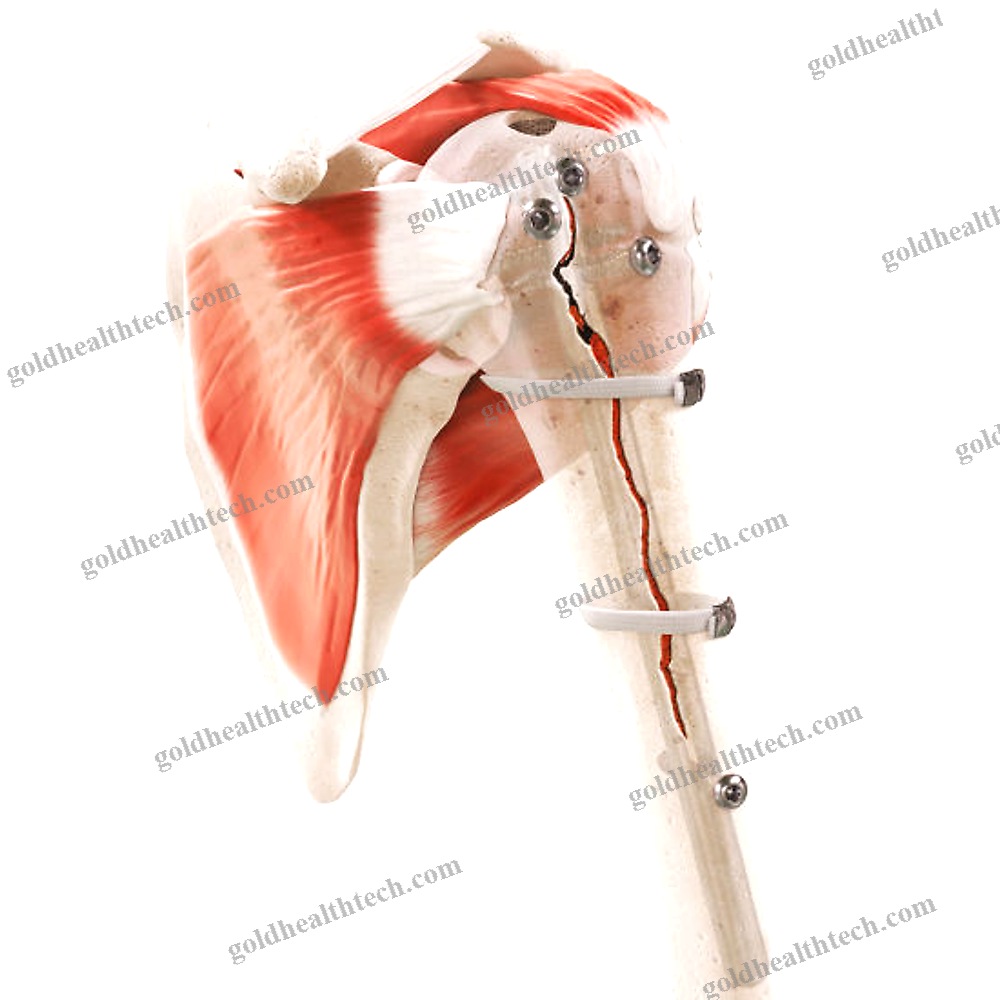 Periprosthetic Fracture Bone Cerclage Wiring