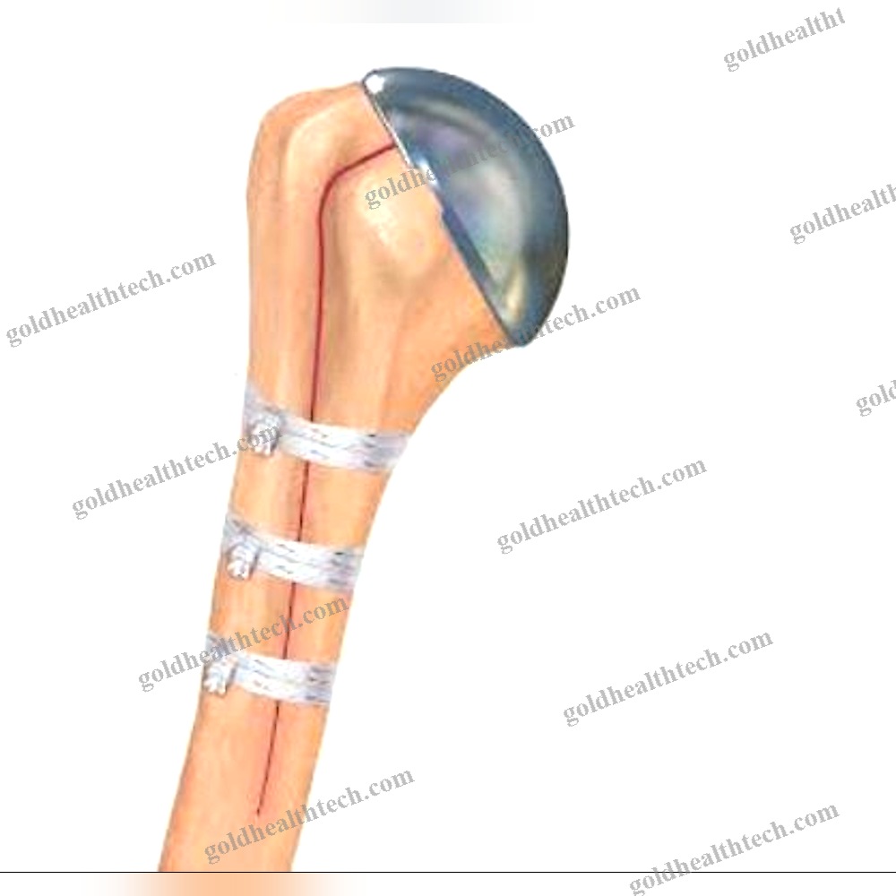 Periprosthetic Fracture Bone Cerclage Wiring 1