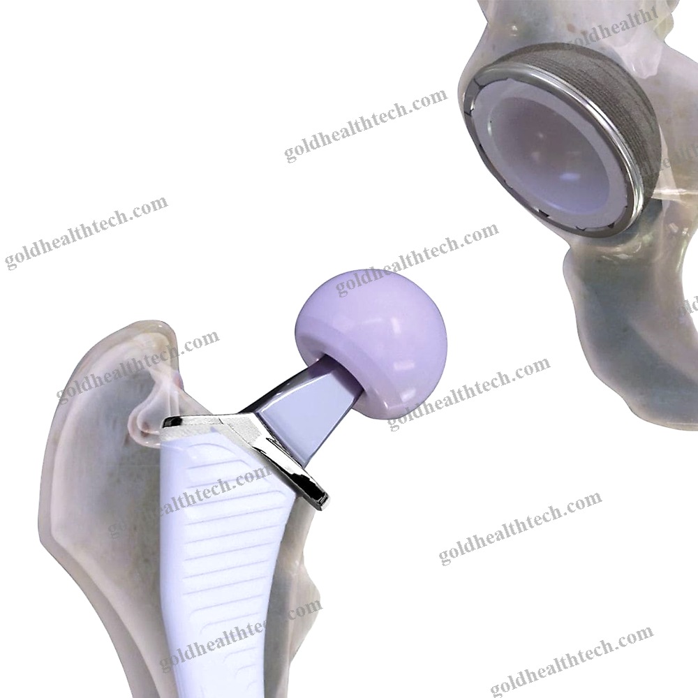 Primary Hip Prosthesis