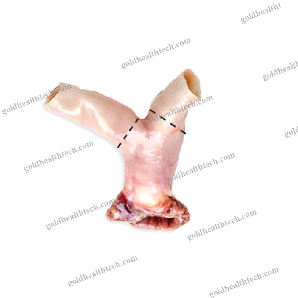 Pulmonary Artery Vascular Bioprosthesis