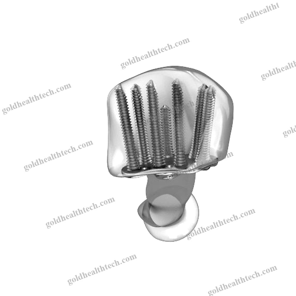 Radius Compression Plate 1