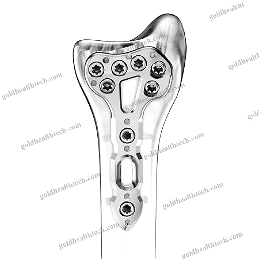 Radius Compression Plate