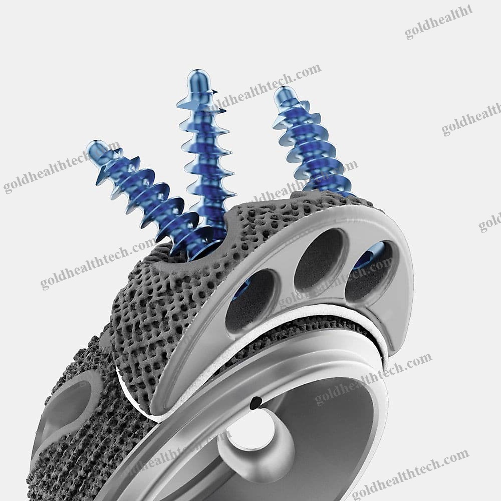 Revision Acetabular Prosthesis