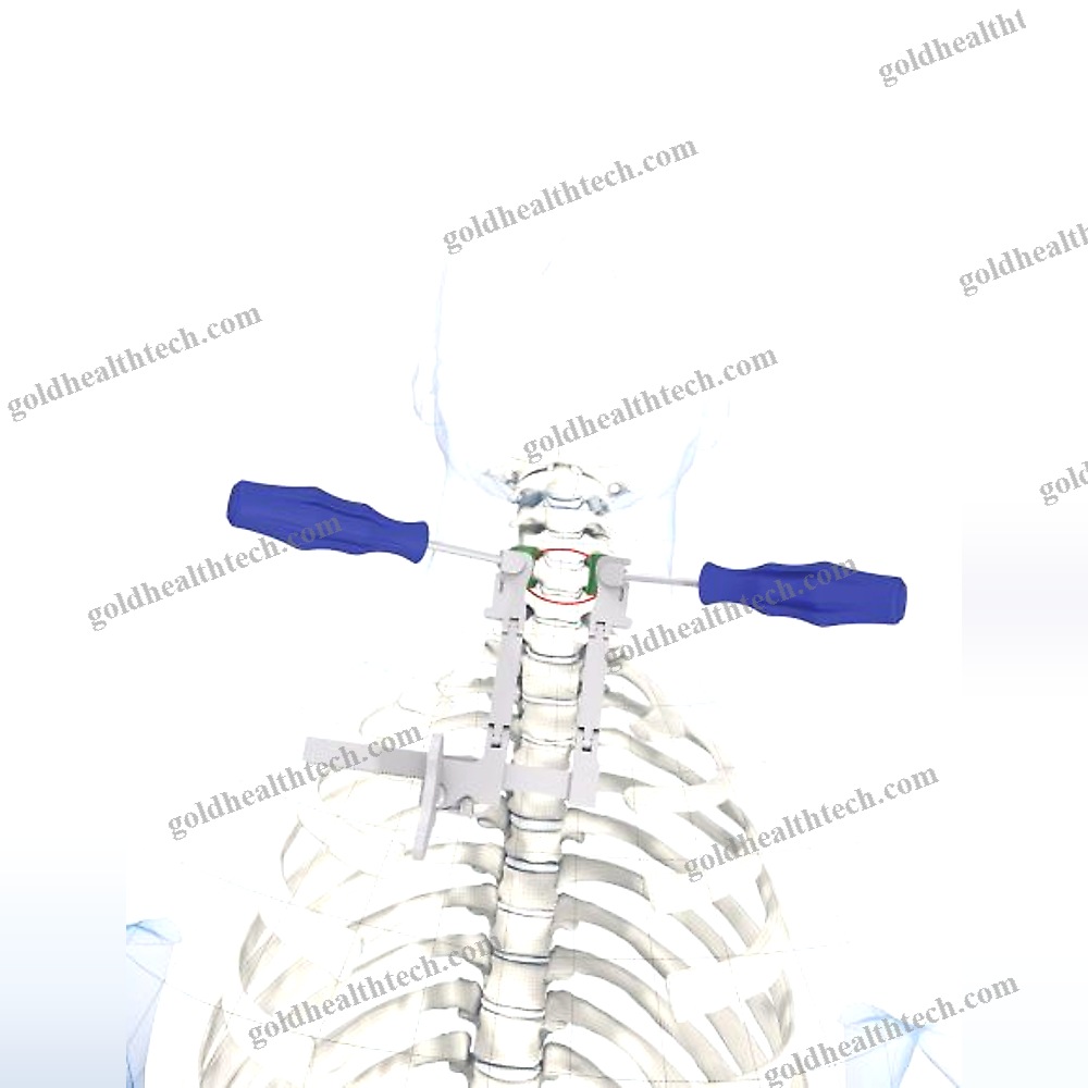 Spinal Retractor 1